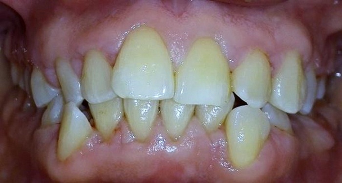 Aspecto periodontal dos meses después de la cirugía